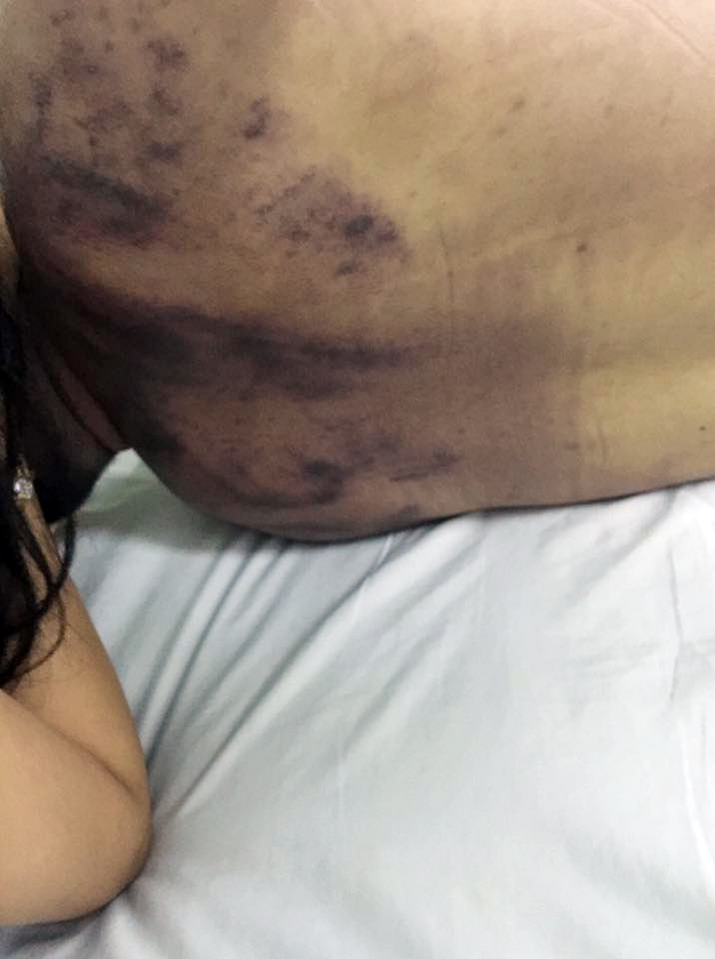 Bruises are seen on Vo Tan Minh’s body. Courtesy of Minh’s family