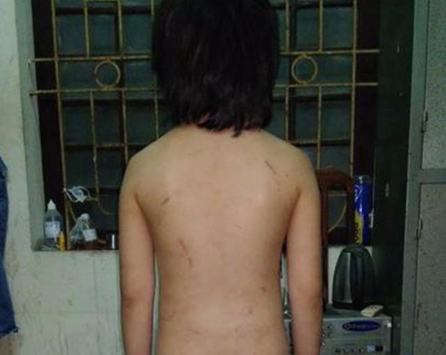 Scars mark the boy’s back in this photo provided by Hanoi police.