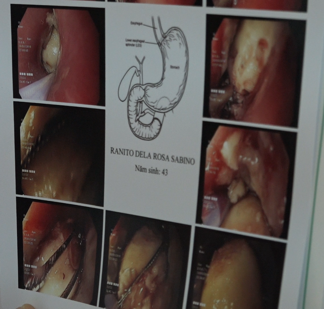 Endoscopic photos depict a sizeable balut stuck in the patient’s throat. Photo: Tuoi Tre