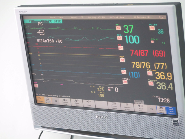 The cardiograph shows the beat rate of the donated heart after the transplant surgery. Photo: Tuoi Tre