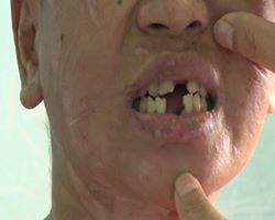 The victim shows her missing teeth, which are said to have been extracted by Nga. Photo: Tuoi Tre
