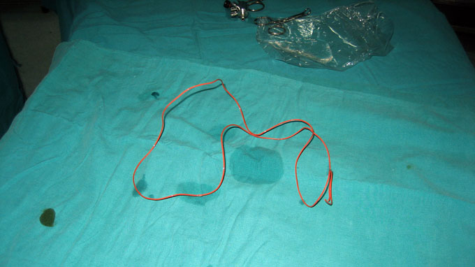 One-meter electric wire removed from boy’s bladder