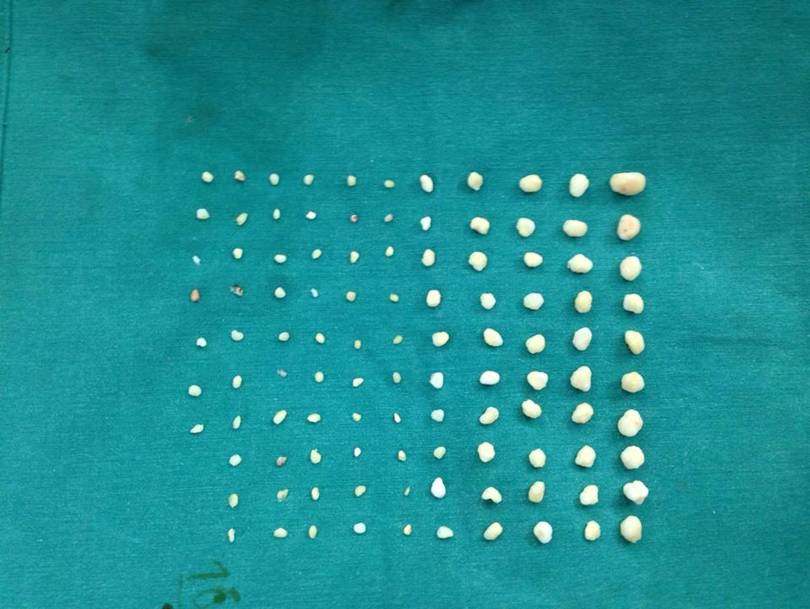 107 stones found in woman’s shoulder joint