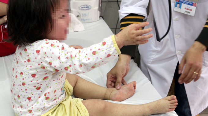 Measles spreads in Hanoi, with dozens of kids affected per day