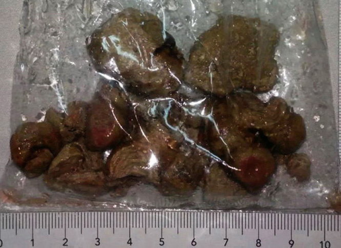 Vietnamese doctors remove 'largest-ever kidney' stone from woman