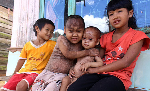 Kids suffering from ‘fish scale disease’ in Vietnam highlands