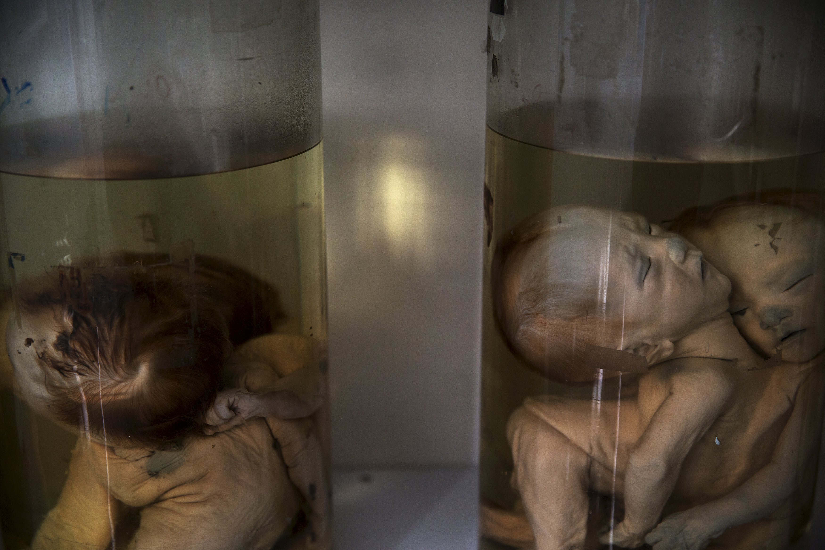 Deformed foetuses are seen inside glass containers in an exhibition room at Peace Village in Tu Du hospital in Ho Chi Minh City April 14, 2015. Doctors at the hospital attribute the high incidence of deformities to the use of Agent Orange during the Vietnam War. According to the head of the Peace Village, more than two-thirds of its over 60 patients are from areas that were heavily sprayed by Agent Orange and their health conditions are linked to the use of the defoliant.