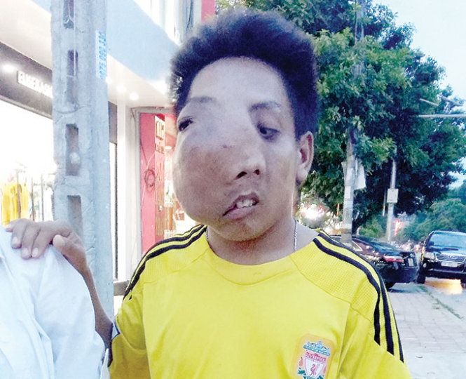 Vietnam man battles huge facial tumor