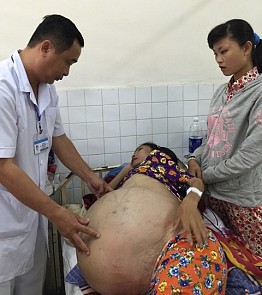 Vietnamese doctors remove 40kg ovarian tumor