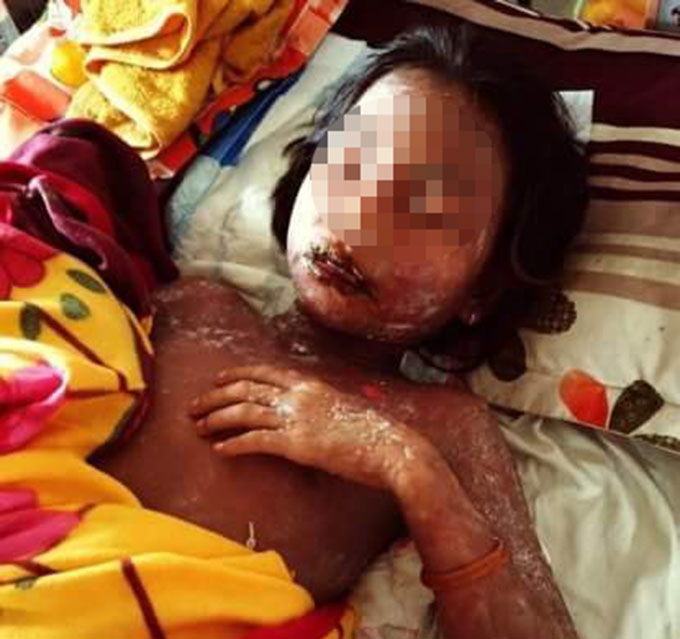 Young Vietnamese girl recovers from serious allergy after drinking soda