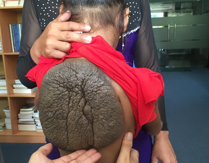 Vietnamese girl has 1kg turtle-shell-like mole removed from back