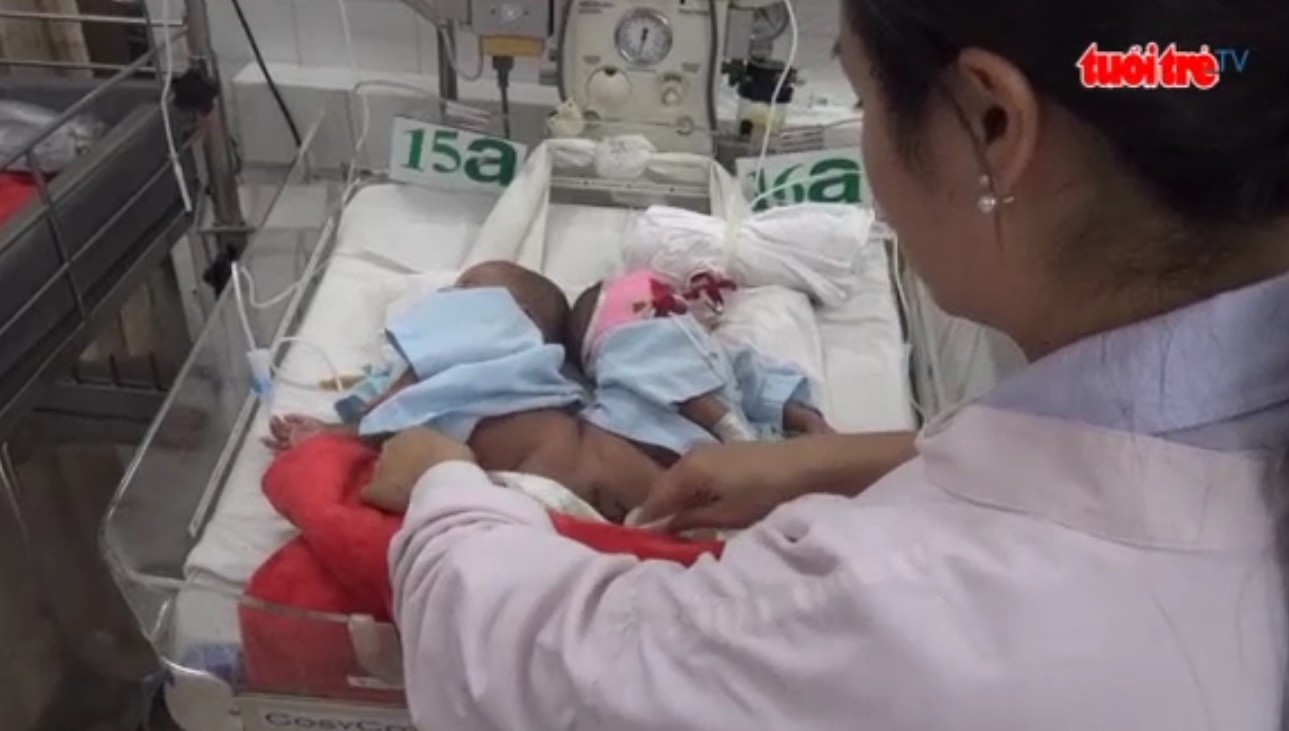 Vietnamese conjoined twin girls to be separated next month