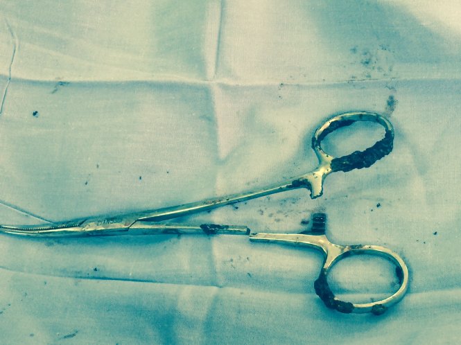 Vietnamese doctors remove pair of scissors colleagues left in patient for 18 years