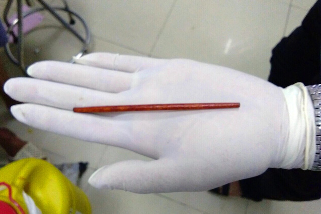 Chopstick removed from Vietnamese man’s penis