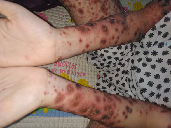 Ho Chi Minh City doctors cure 13-yo girl of rare skin disorder