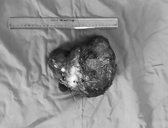 Doctors cut off 2kg tumor from kidneys of child in Vietnam