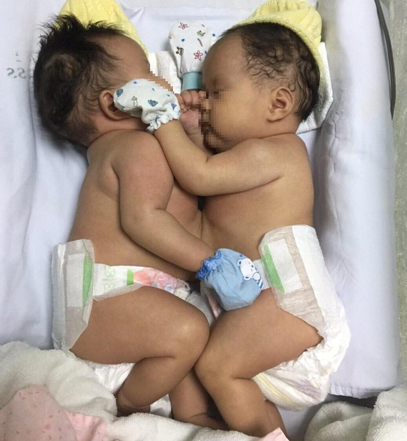 Ho Chi Minh City doctors successfully separate twin girls with conjoined livers