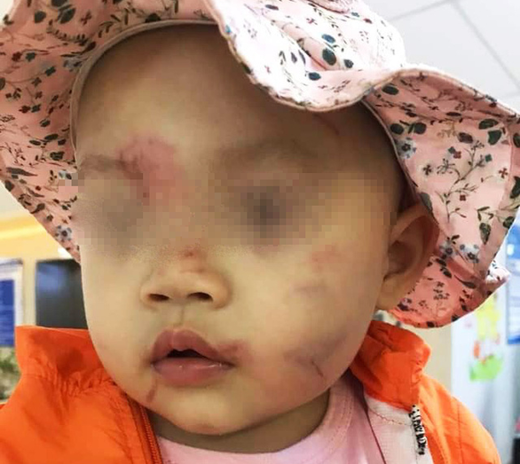 Vietnam girl goes home covered in bruises on first day of preschool