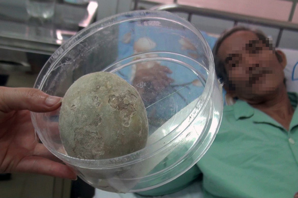 Apple-sized stone removed from 61-yo Vietnamese man’s bladder