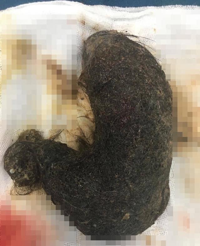 Vietnamese tween has huge hairball removed from stomach