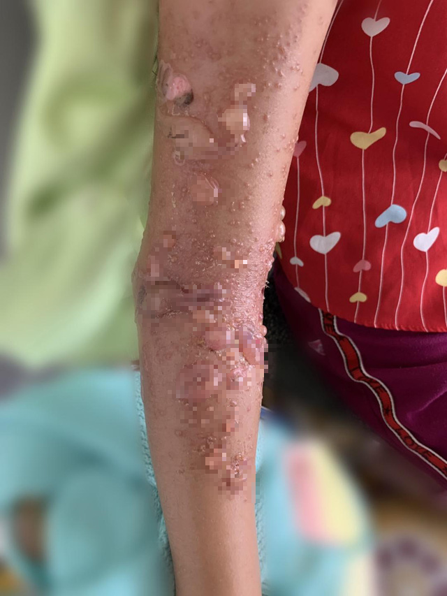 Child hospitalized for suspected jellyfish stings in Vietnam