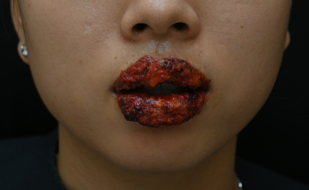 Vietnamese woman suffers complications after lip blush