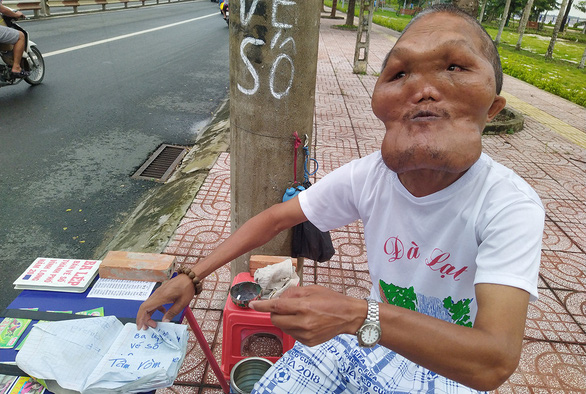 Vietnamese man with facial disfigurement keeps on smiling, feeding birds