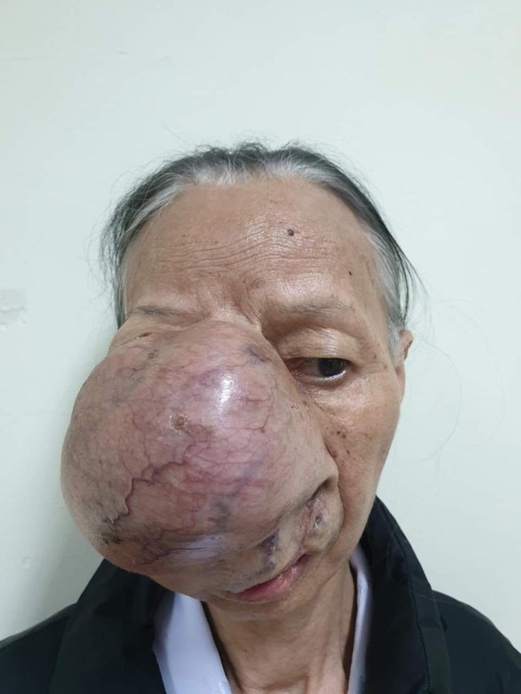 In Vietnam, four hospitals join surgery to remove tumor occupying most of patient’s face