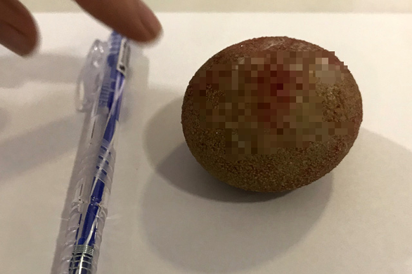 Egg-sized stone removed from Vietnamese man’s bladder