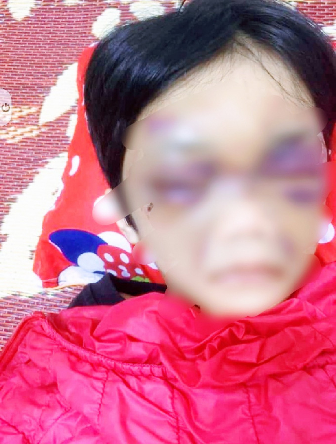 6-year-old girl brutally beaten by mother in northern Vietnam
