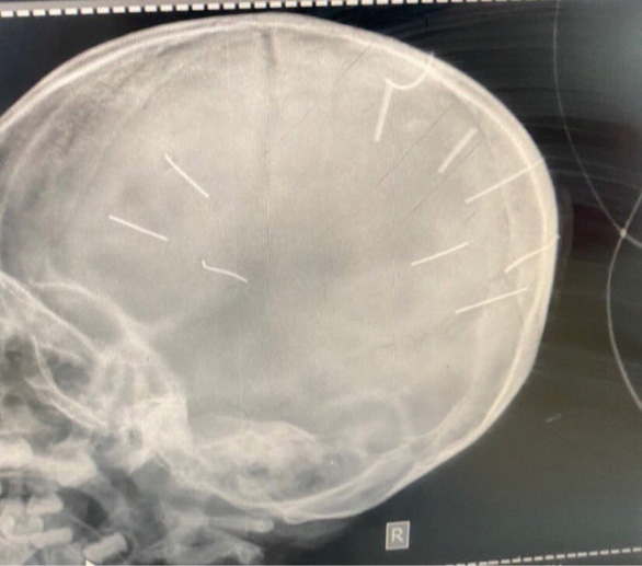 Little Vietnamese girl hospitalized with 9 nail-like objects in head, prompting police investigation