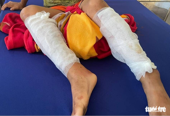 Father burns son’s legs over theft allegations in north-central Vietnam