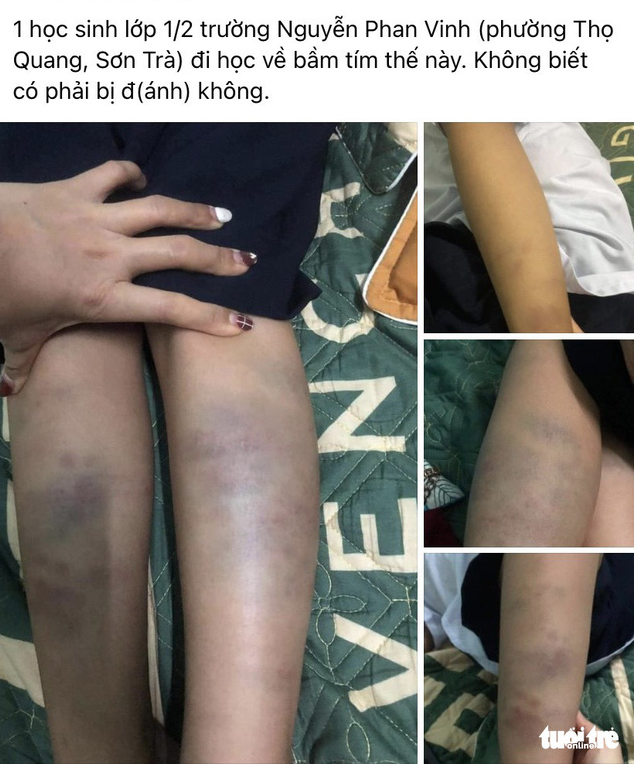 First grader suffers bruised arms, legs after being hit by classmate in Vietnam