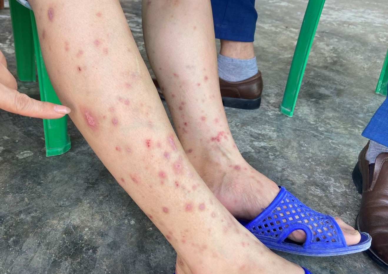 Fleas cause 160 allergic dermatitis cases in north-central Vietnam