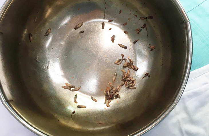 Doctors remove dozens of maggots from man's tracheostomy stoma