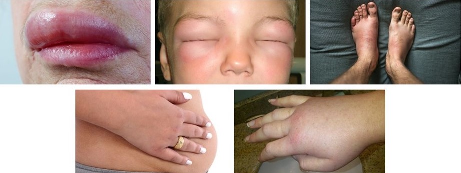 Challenges in diagnosis, treatment of hereditary angioedema in Vietnam