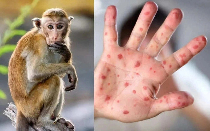 Da Nang’s suspected monkeypox case confirmed as HFMD patient
