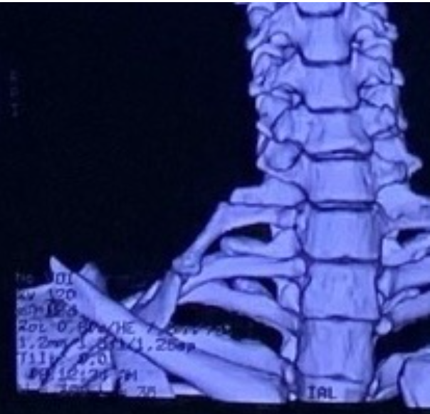 A medical scan shows Vi Thi Th.'s abnormal bone mass. Photo: Supplied