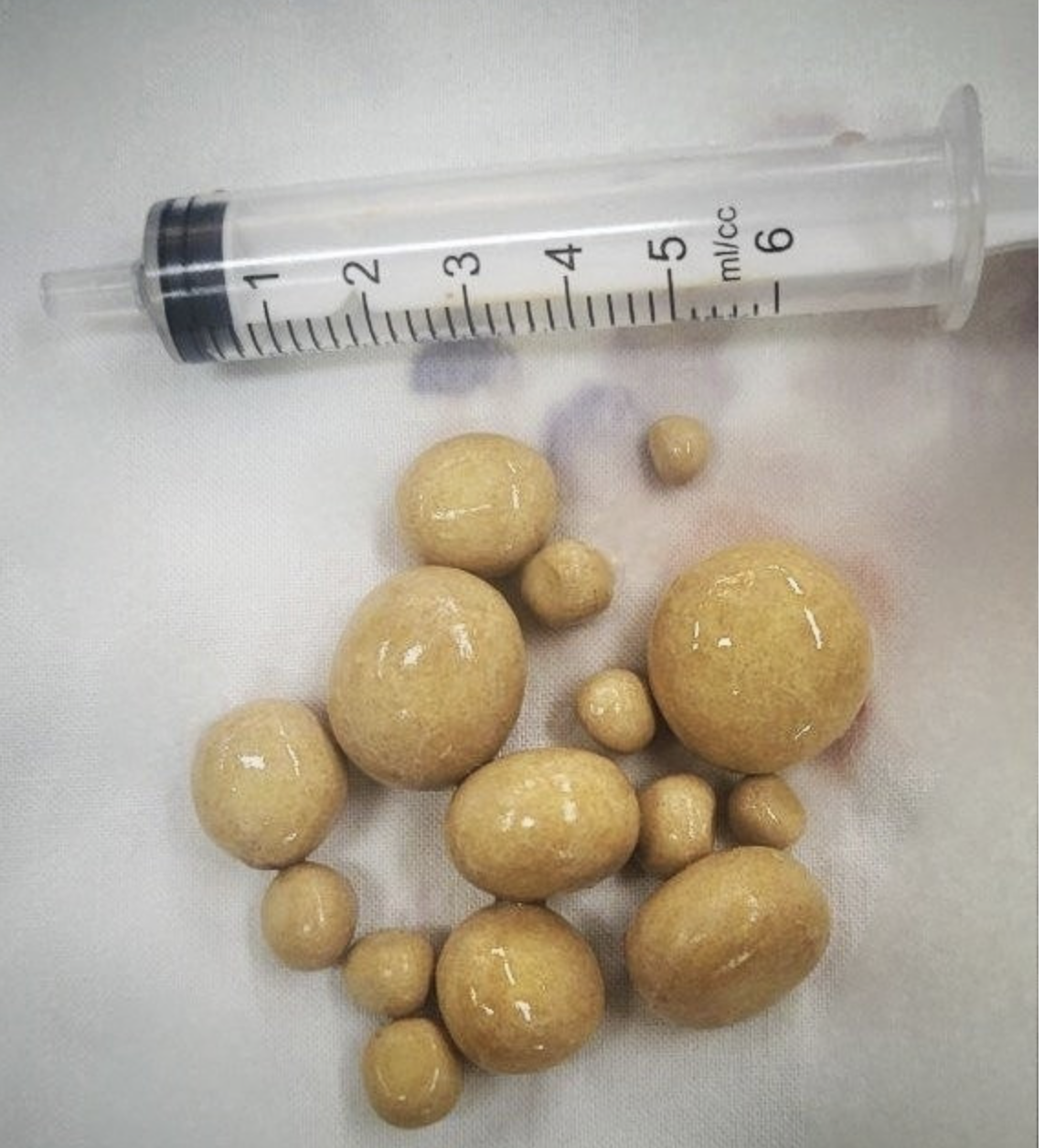 15 stones removed from Vietnamese man’s bladder