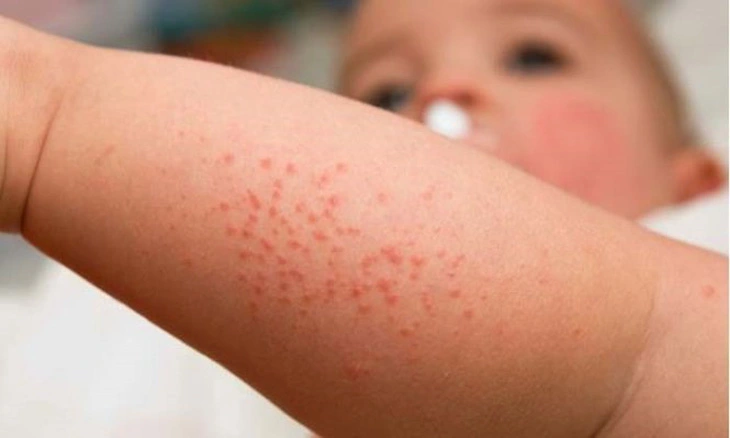 This file image shows rashes on the body of a baby with measles in Vietnam.