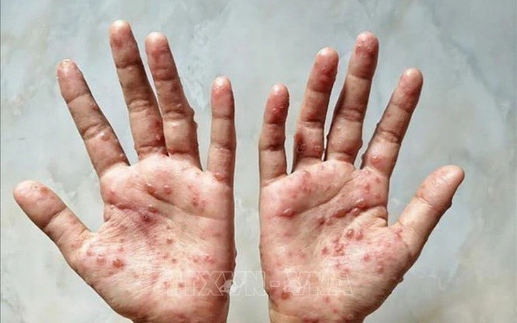 Mpox infects 199, claims 8 lives in southern Vietnam since 2023