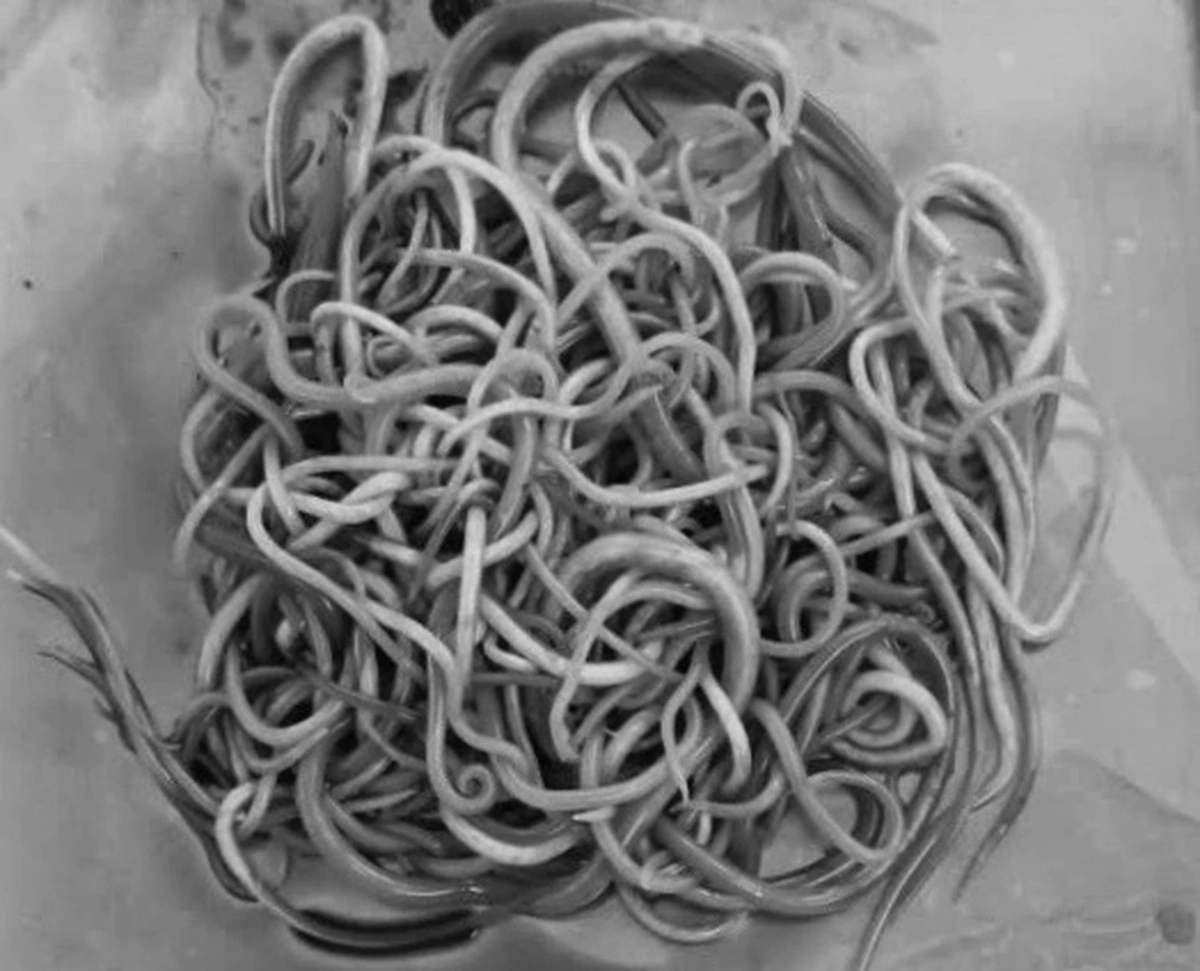 Vietnamese doctors remove over 100 roundworms from small intestine of 2.5-year-old