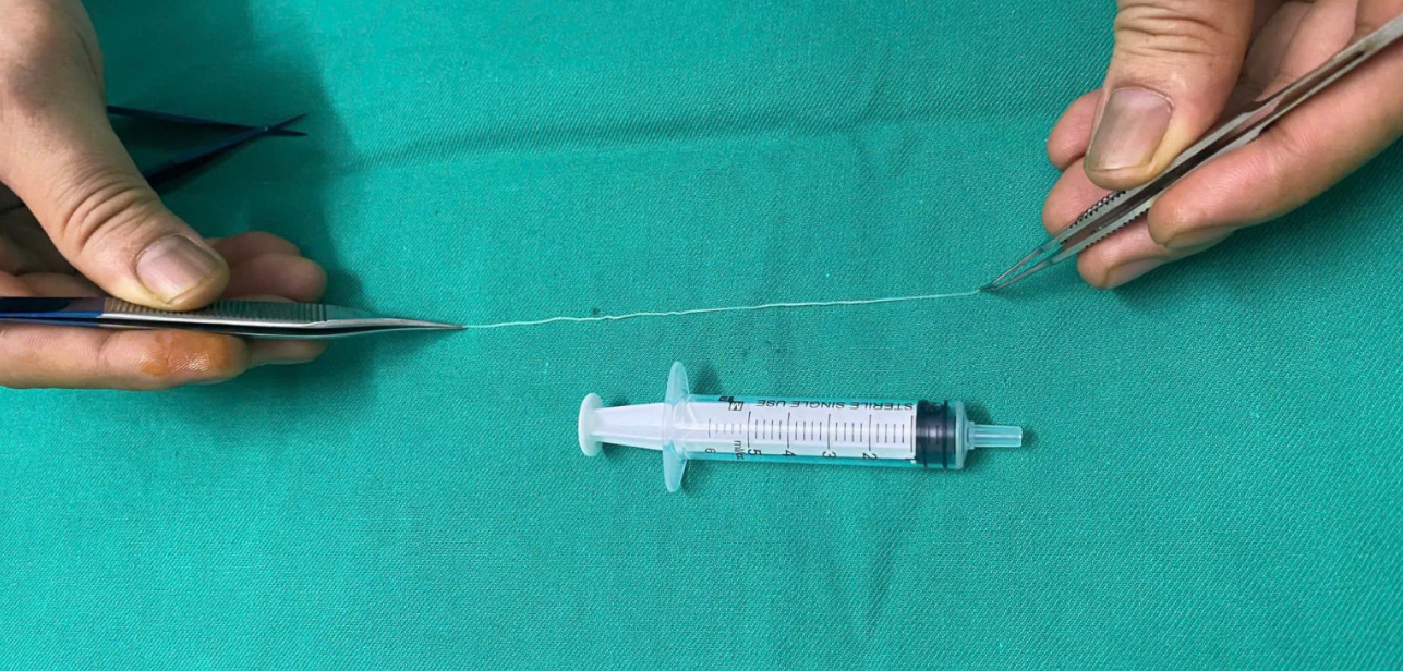 In Vietnam, 14cm worm removed from patient’s eye