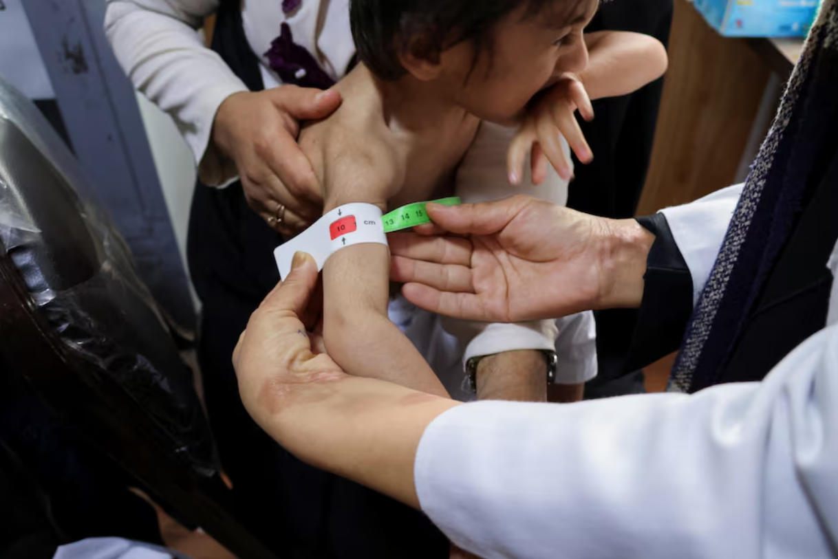 A doctor measures the upper arm of Habib, a three-year-old boy, suffering from severe acute malnutrition in Yaka Dokan village, Herat, Afghanistan, October 23, 2024. Photo: Reuters