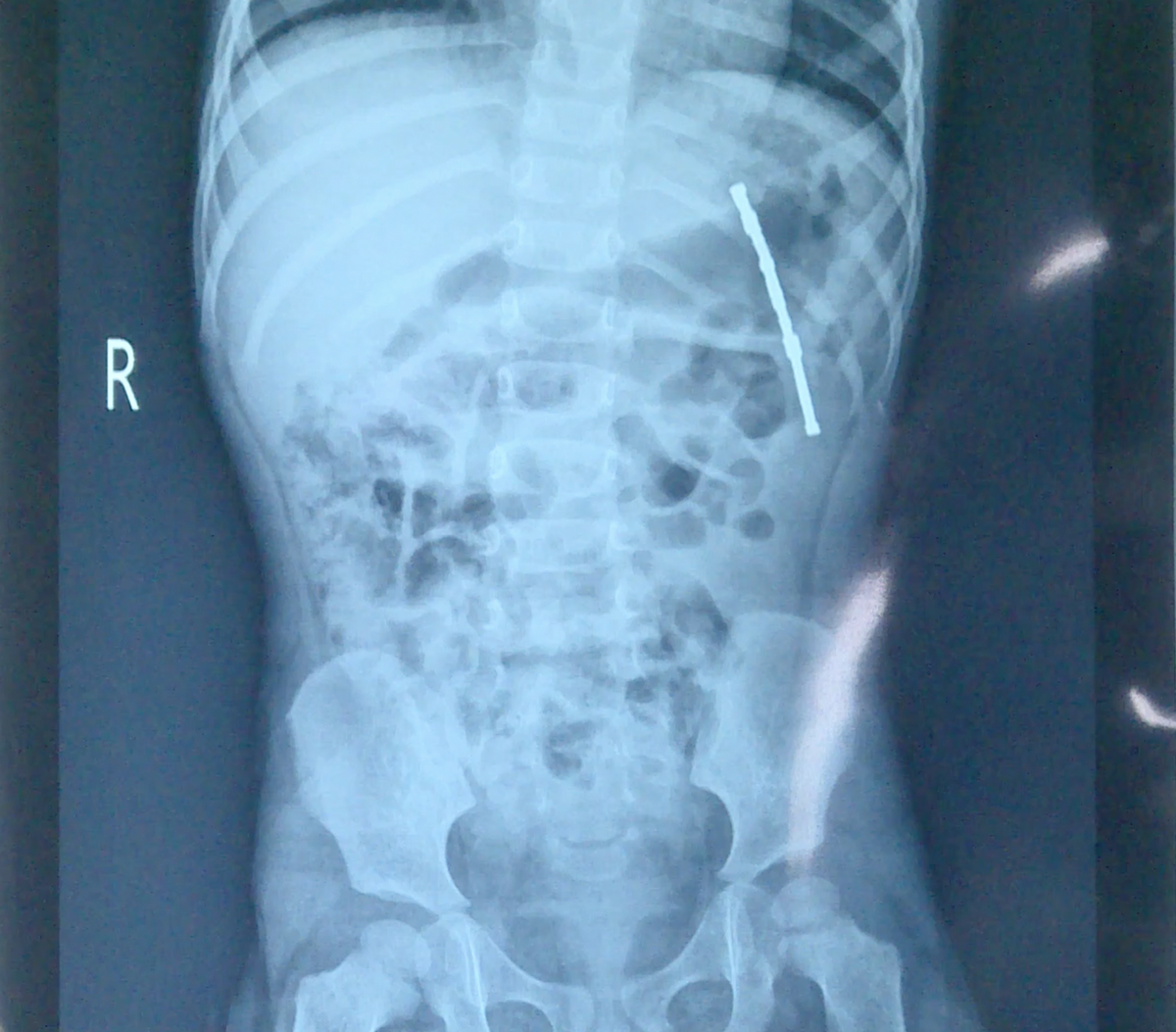 An X-ray image shows foreign objects in the girl’s intestine. Photo: A.B.