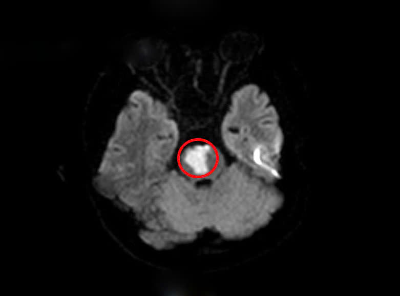 Northern Vietnamese hospital treats 17-year-old with cerebral infarction